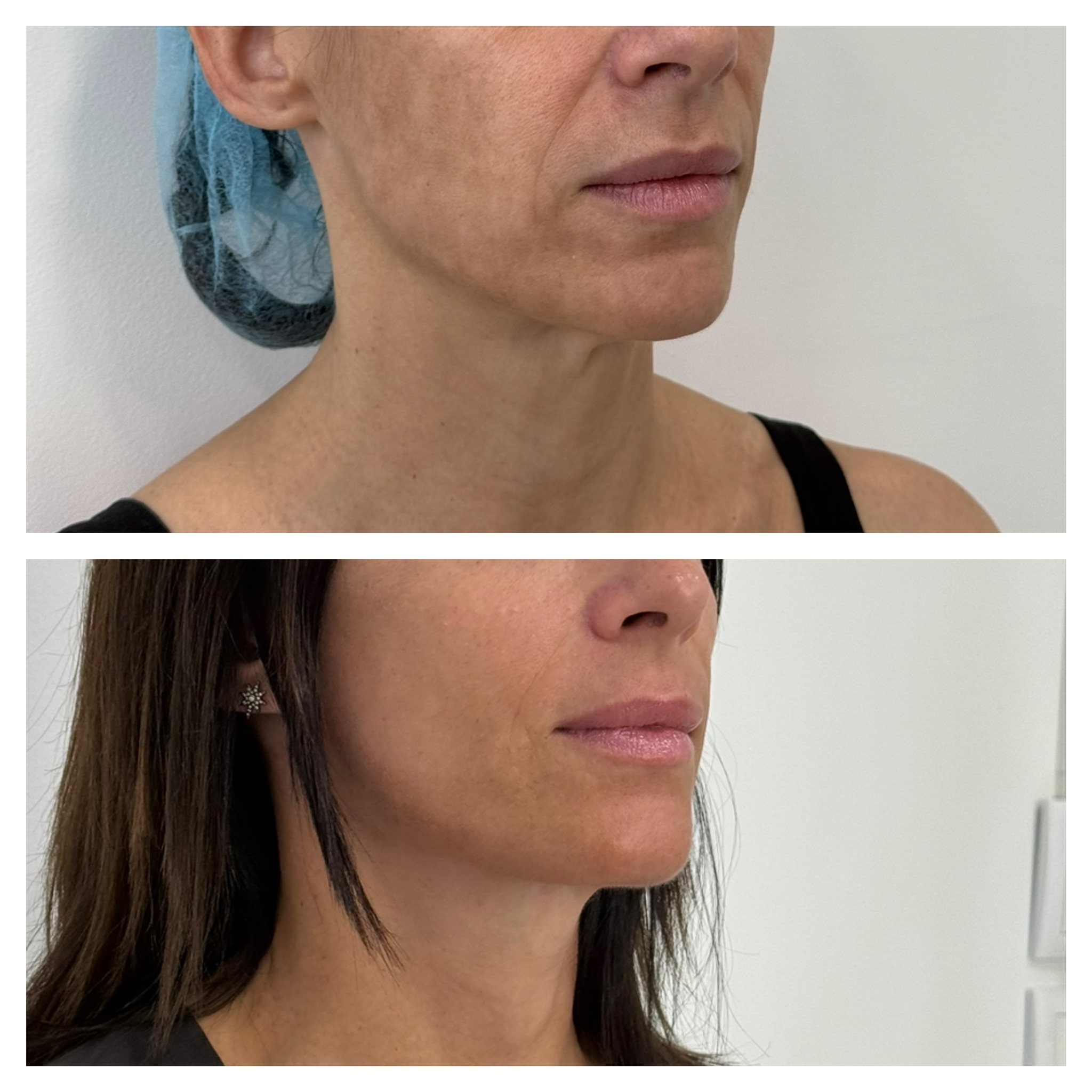 Resultado de lifting facial: Le preocupaban la caída del rostro y las bandas del cuello