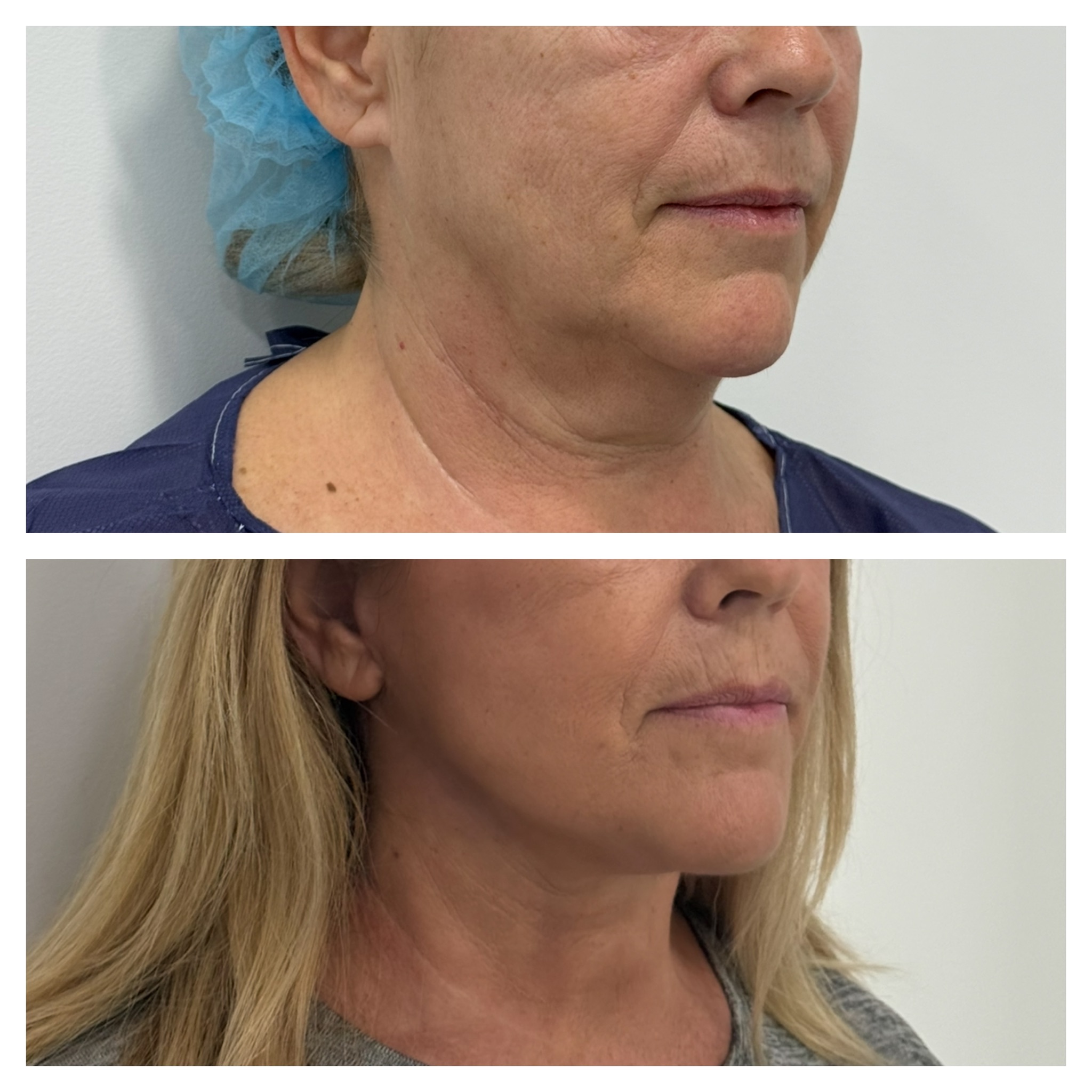 Resultado de lifting facial: El cuello y la papada eran su principal preocupación