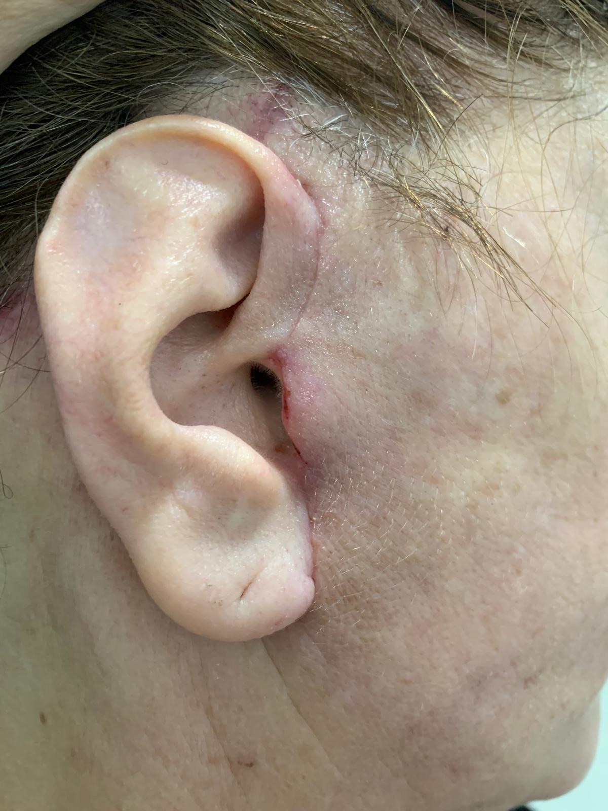 Detalle de una cicatriz de lifting facial